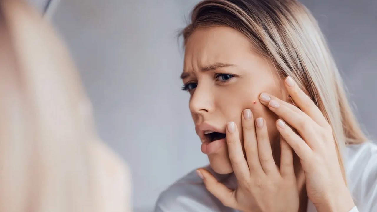 Foto - Uzman isim açıkladı: Cilt lekeleri nasıl geçer? Cilt lekelerine hangi vitaminler iyi gelir?