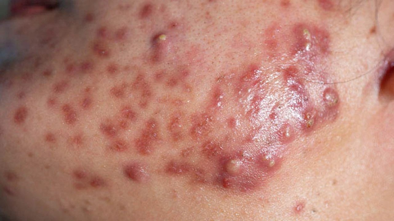 Uzman isim açıkladı: Cilt lekeleri nasıl geçer? Cilt lekelerine hangi vitaminler iyi gelir?