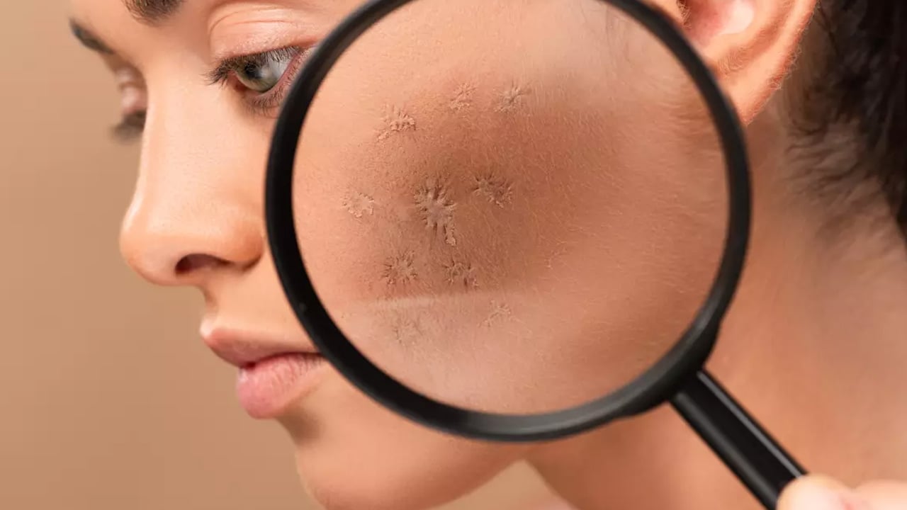 Foto - Uzman isim açıkladı: Cilt lekeleri nasıl geçer? Cilt lekelerine hangi vitaminler iyi gelir?