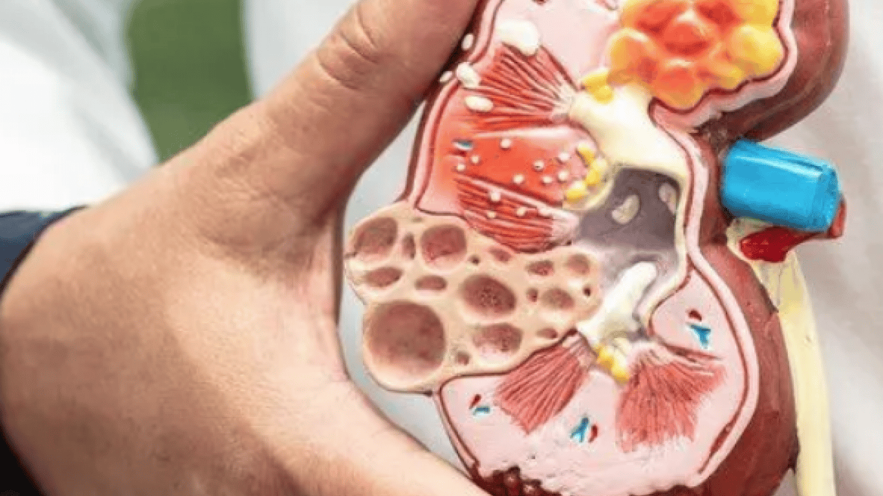 Foto - Uzman isim açıkladı: Doğru beslenme ile böbrek taşı riskini azaltmak mümkün