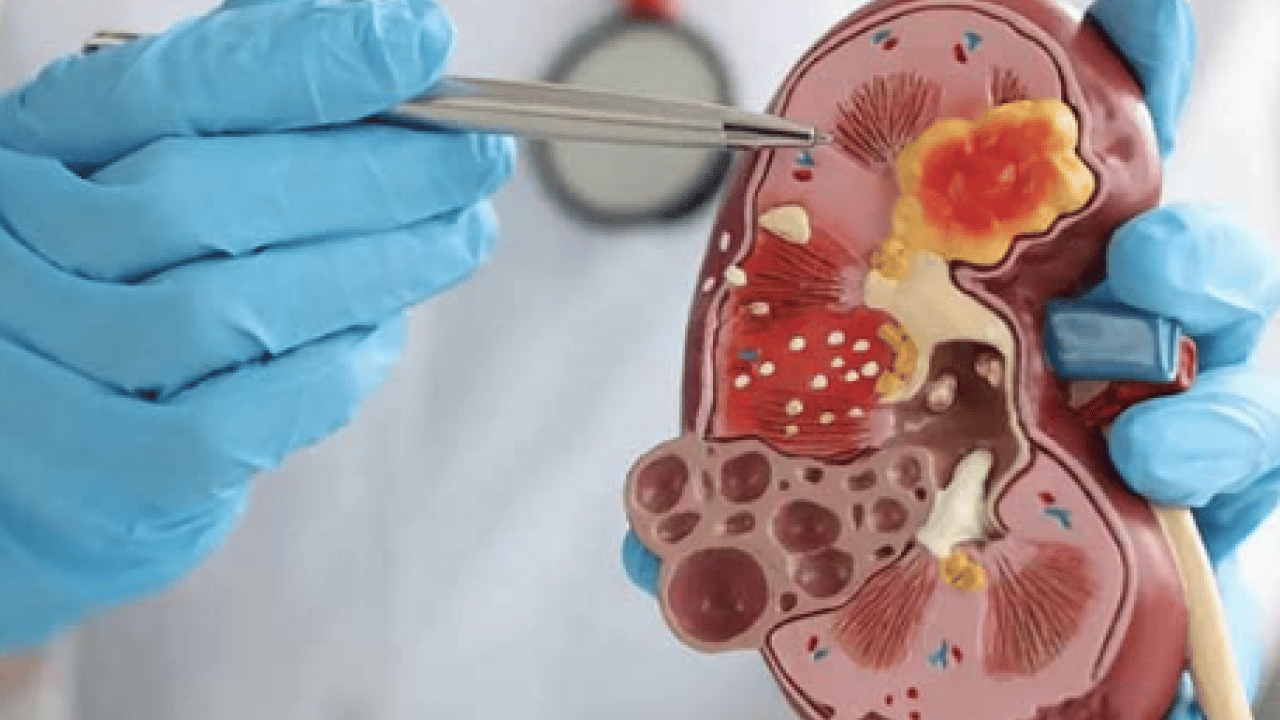 Foto - Uzman isim açıkladı: Doğru beslenme ile böbrek taşı riskini azaltmak mümkün