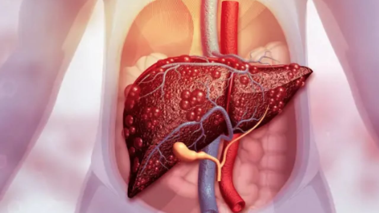 Foto - Uzman isim korkunç haberi verdi: 2050'ye kadar 2 milyar kişi karaciğer hastası olabilir! 