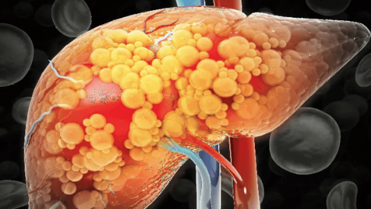 Foto - Uzman isim korkunç haberi verdi: 2050'ye kadar 2 milyar kişi karaciğer hastası olabilir! 