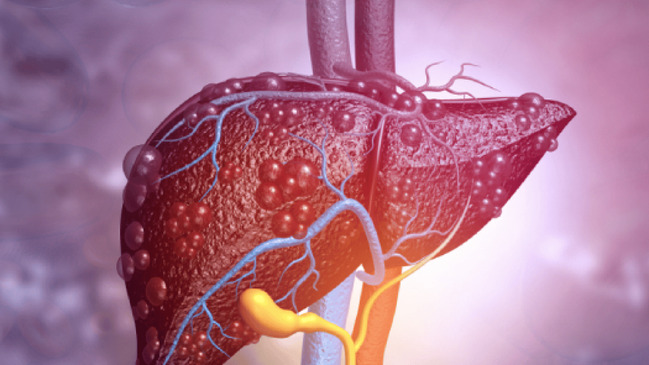 Foto - Uzman isim korkunç haberi verdi: 2050'ye kadar 2 milyar kişi karaciğer hastası olabilir! 