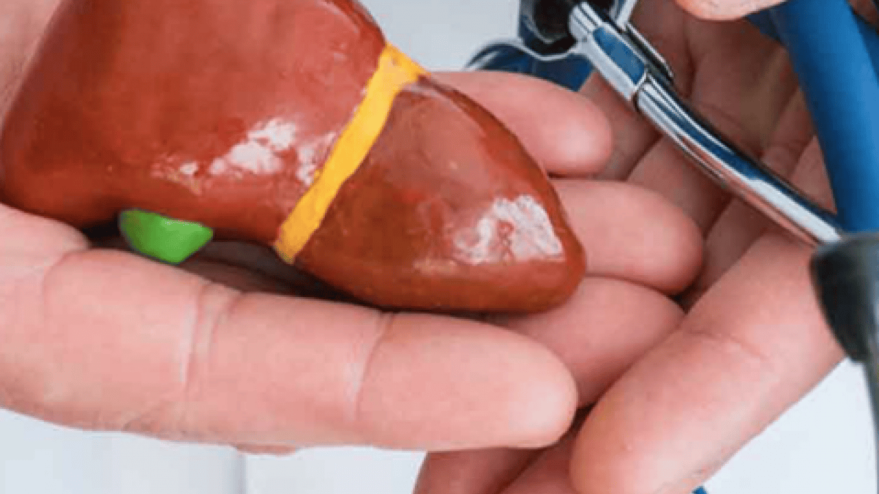 Foto - Uzman isim korkunç haberi verdi: 2050'ye kadar 2 milyar kişi karaciğer hastası olabilir! 