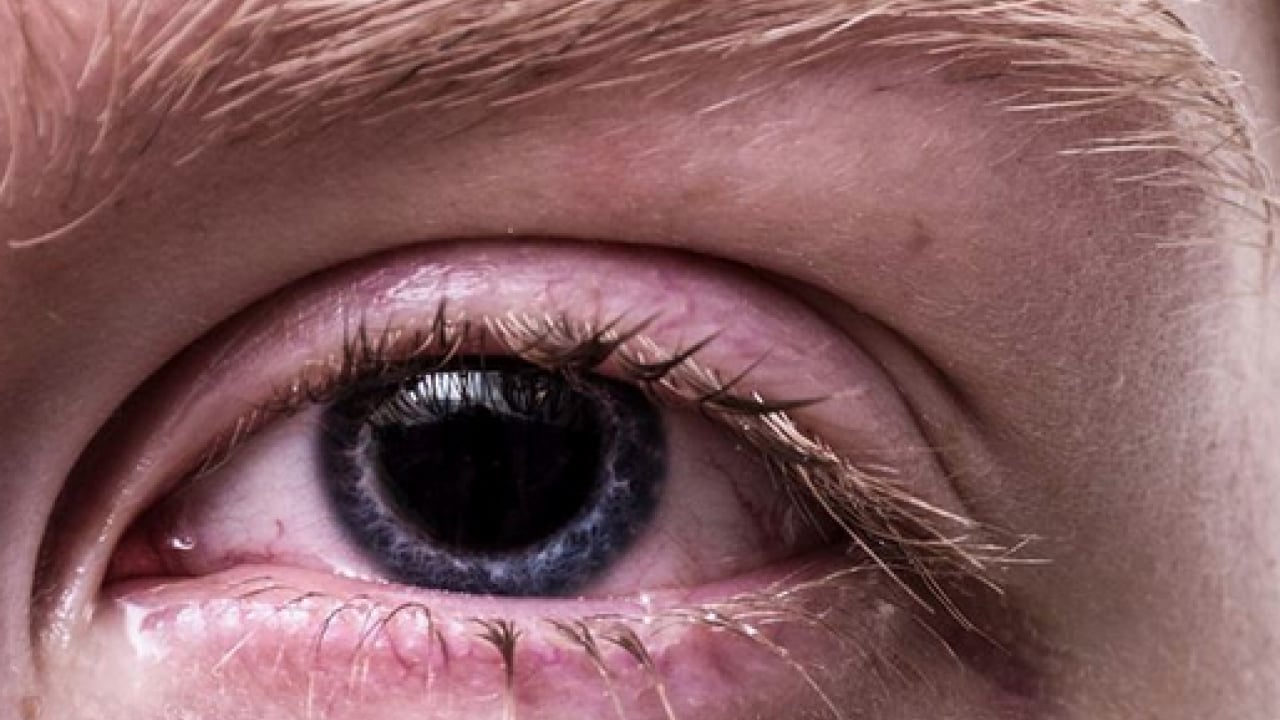 Foto - Uzman isimden çok ciddi uyarı! Bahar aylarındaki göz alerjisi görme kaybına yol açabilir...