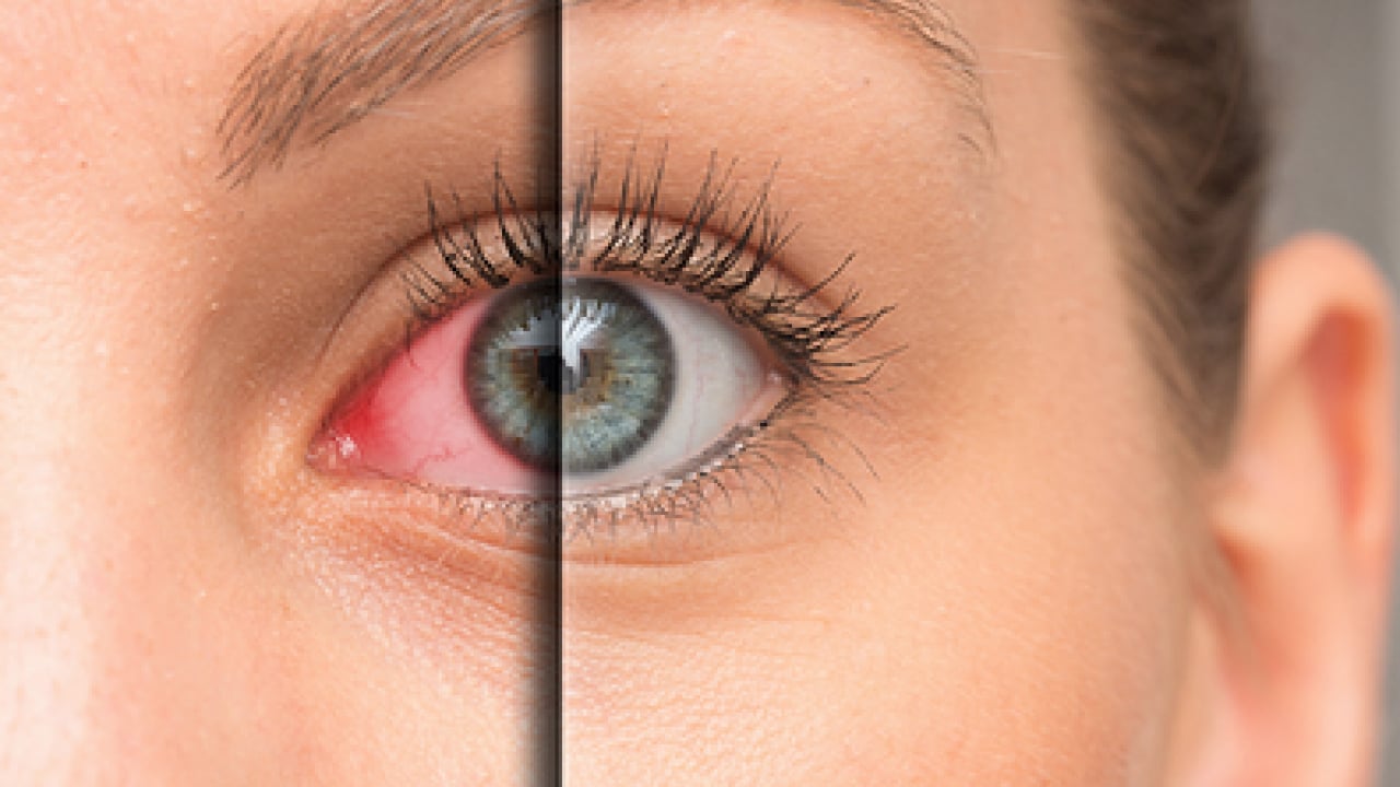 Uzman isimden çok ciddi uyarı! Bahar aylarındaki göz alerjisi görme kaybına yol açabilir...