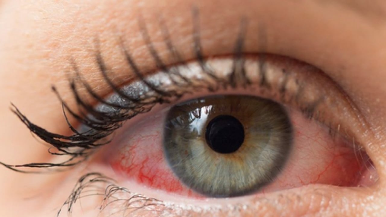 Foto - Uzman isimden çok ciddi uyarı! Bahar aylarındaki göz alerjisi görme kaybına yol açabilir...