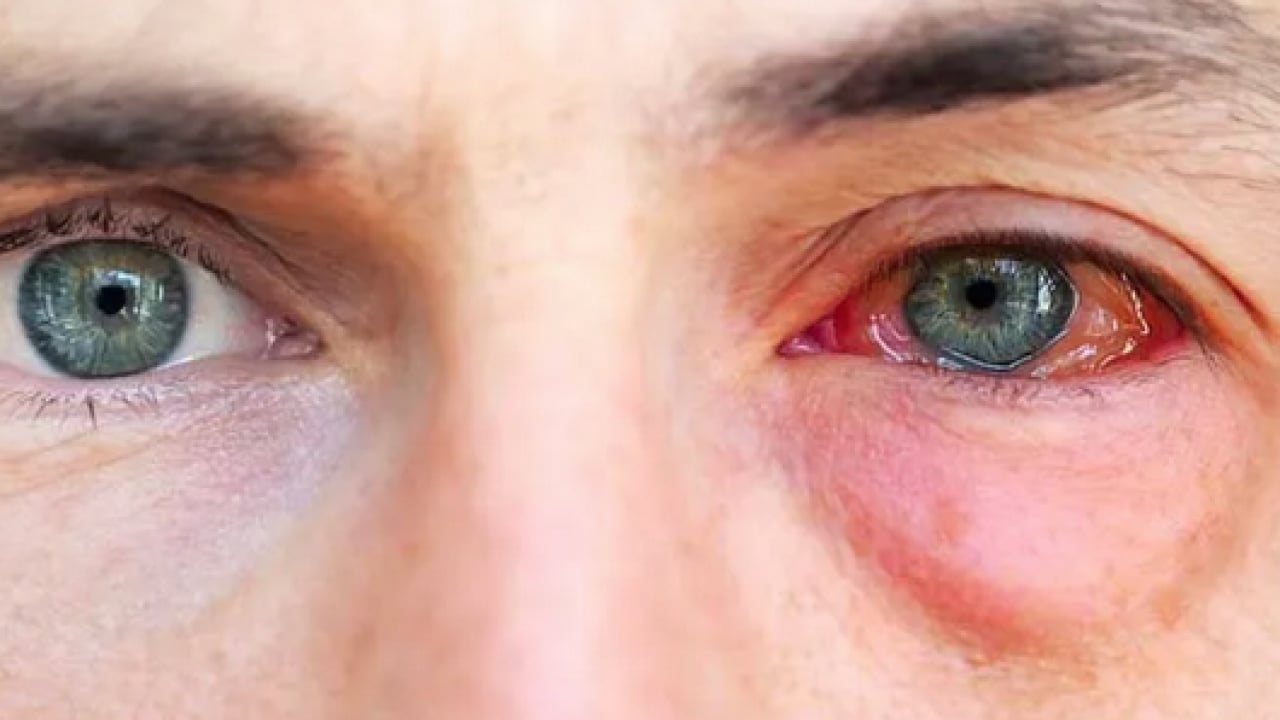 Foto - Uzman isimden çok ciddi uyarı! Bahar aylarındaki göz alerjisi görme kaybına yol açabilir...