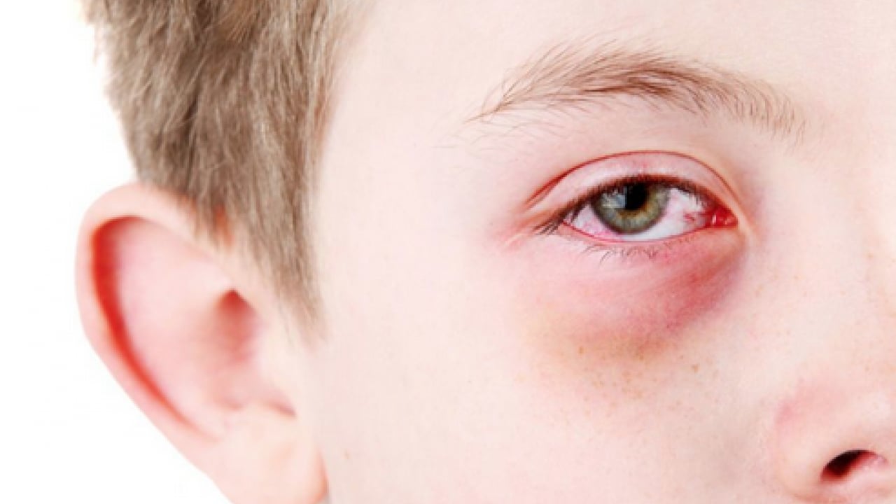 Foto - Uzman isimden çok ciddi uyarı! Bahar aylarındaki göz alerjisi görme kaybına yol açabilir...