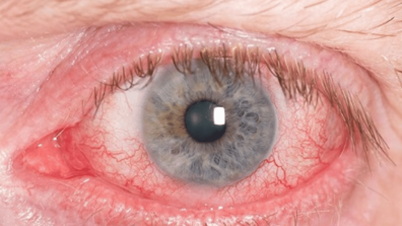 Foto - Uzman isimden çok ciddi uyarı! Bahar aylarındaki göz alerjisi görme kaybına yol açabilir...