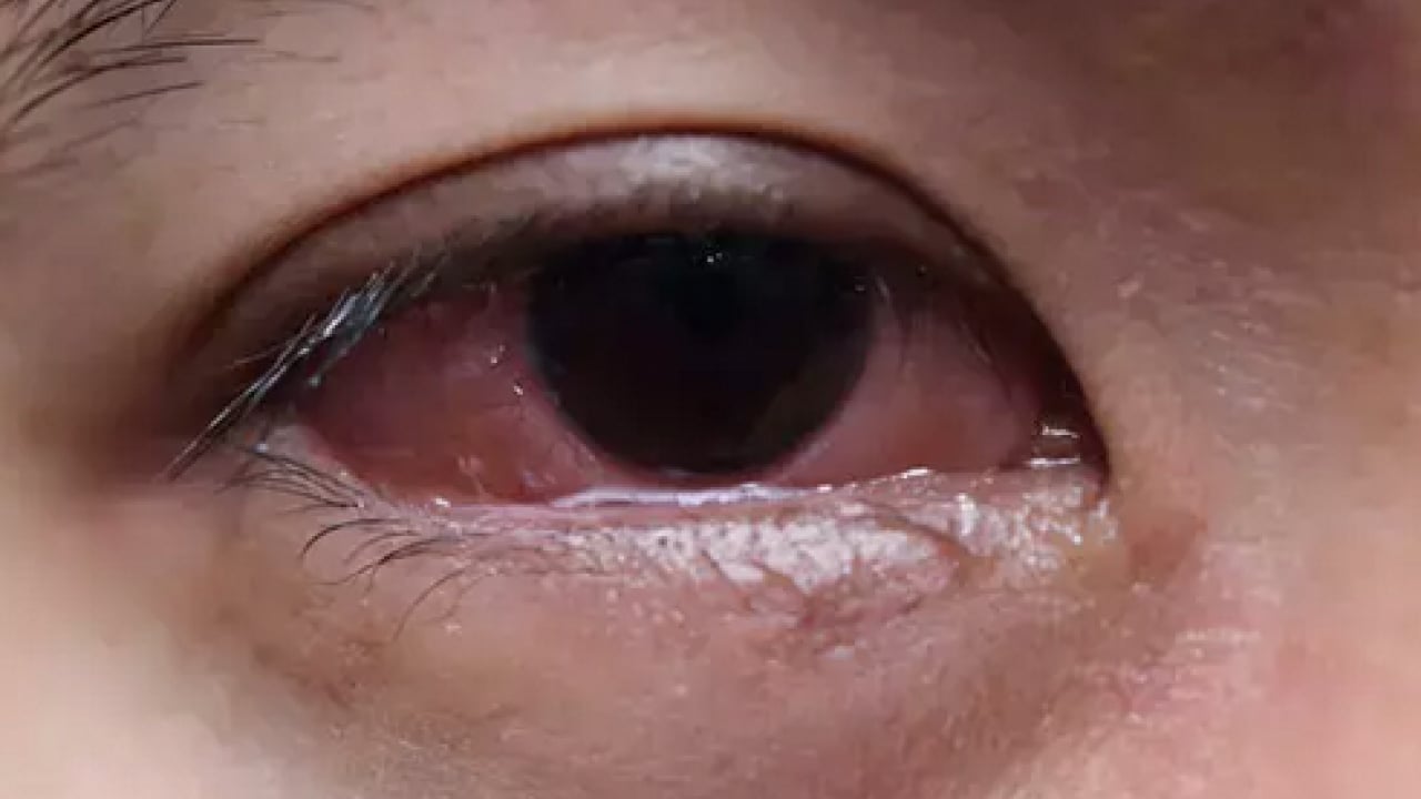 Foto - Uzman isimden çok ciddi uyarı! Bahar aylarındaki göz alerjisi görme kaybına yol açabilir...