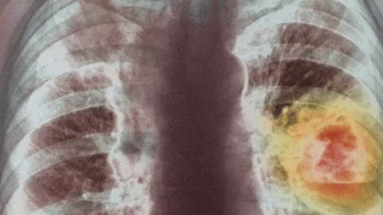 Foto - Uzmandan kronik akciğer hastalarına 'hareket' çağrısı! Pulmoner rehabilitasyon ile destek...