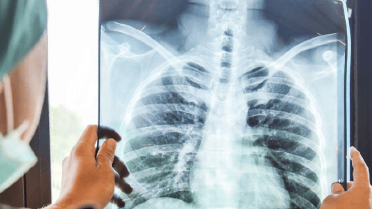 Uzmandan kronik akciğer hastalarına 'hareket' çağrısı! Pulmoner rehabilitasyon ile destek...