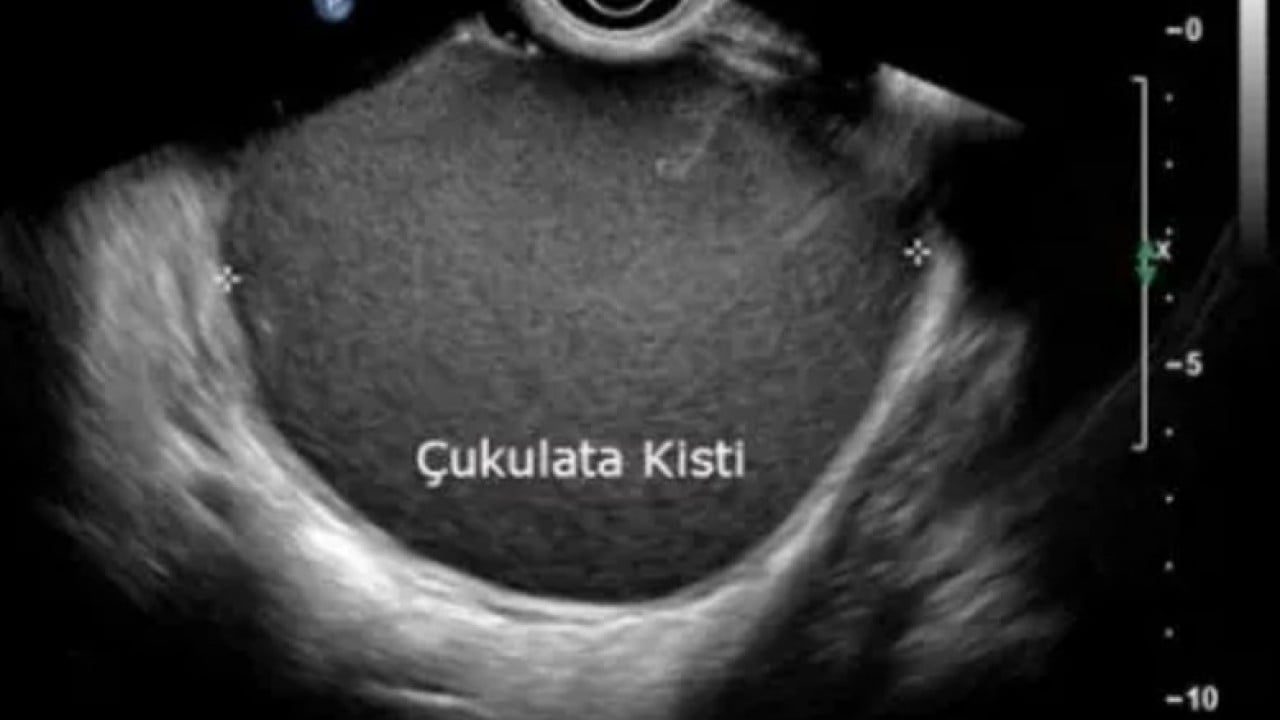 Foto - Uzmanı açıkladı: Her 10 kadından biri ‘çikolata kisti’ ile yaşıyor