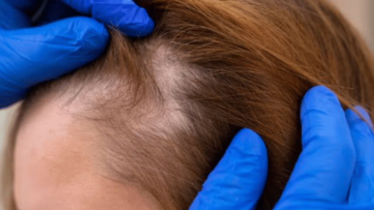 Foto - Uzmanı ‘bunu asla yapmayın’ dedi! Saç dökülmesi sorunu yaşayanlar dikkat