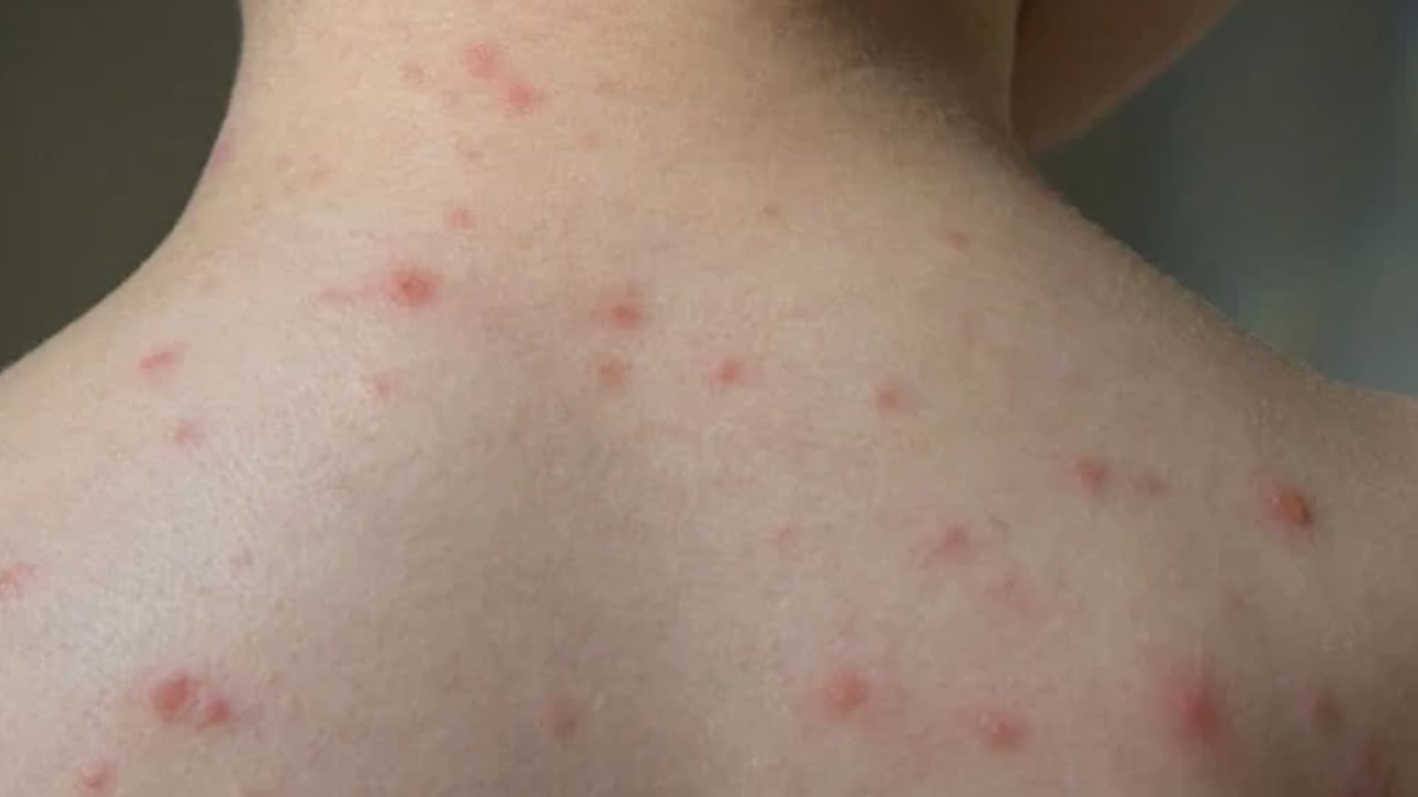 Uzm. Dr. Erdoğan: Çocukluk çağında su çiçeği ve kabakulak sık görülür uyarısı yapıyor! Hangi belirti ne anlama geliyor? 