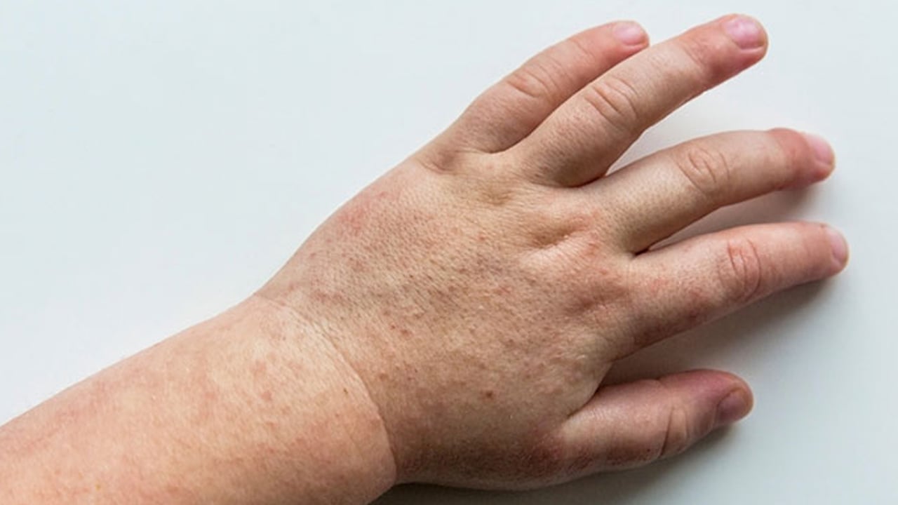 Foto - Uzm. Dr. Erdoğan: Çocukluk çağında su çiçeği ve kabakulak sık görülür uyarısı yapıyor! Hangi belirti ne anlama geliyor? 