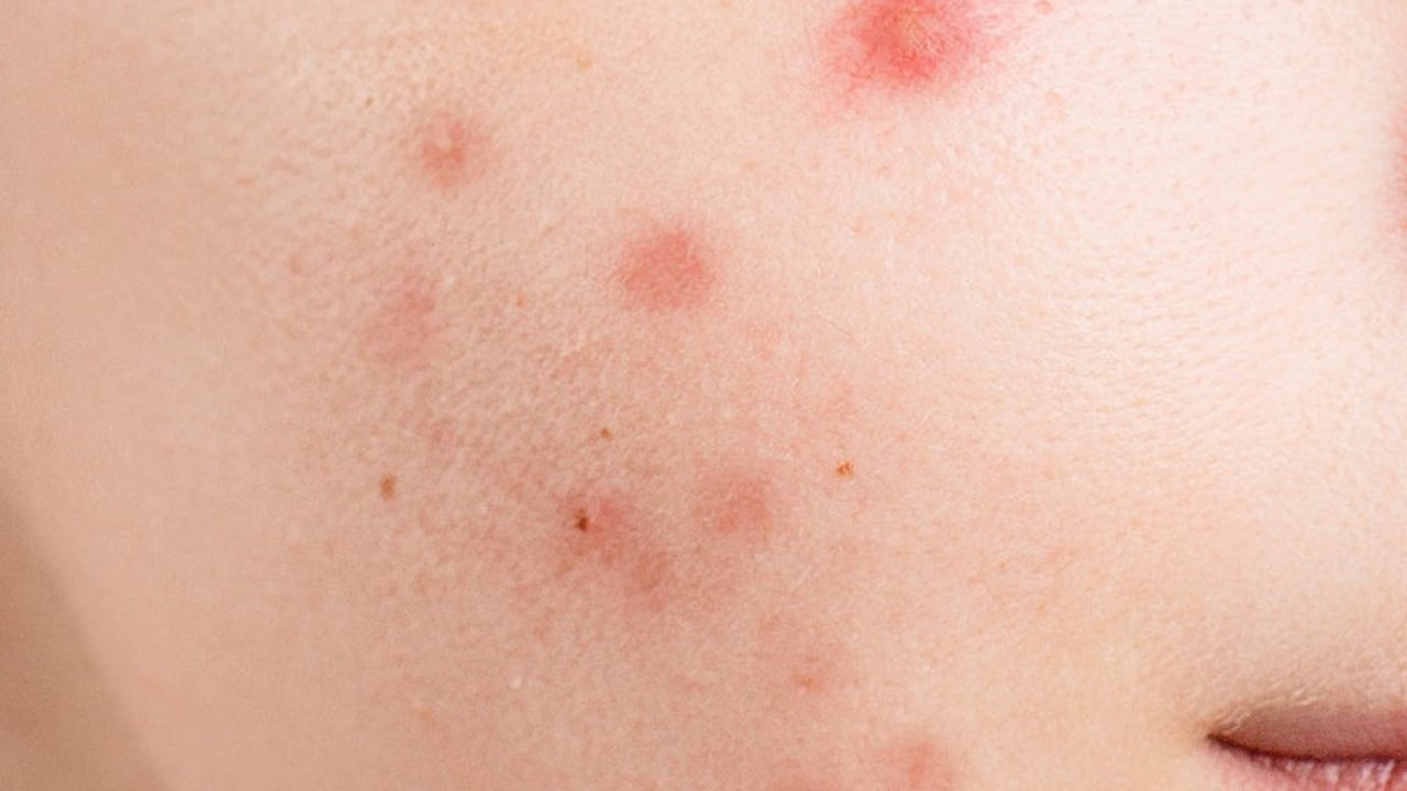 Foto - Uzm. Dr. Erdoğan: Çocukluk çağında su çiçeği ve kabakulak sık görülür uyarısı yapıyor! Hangi belirti ne anlama geliyor? 