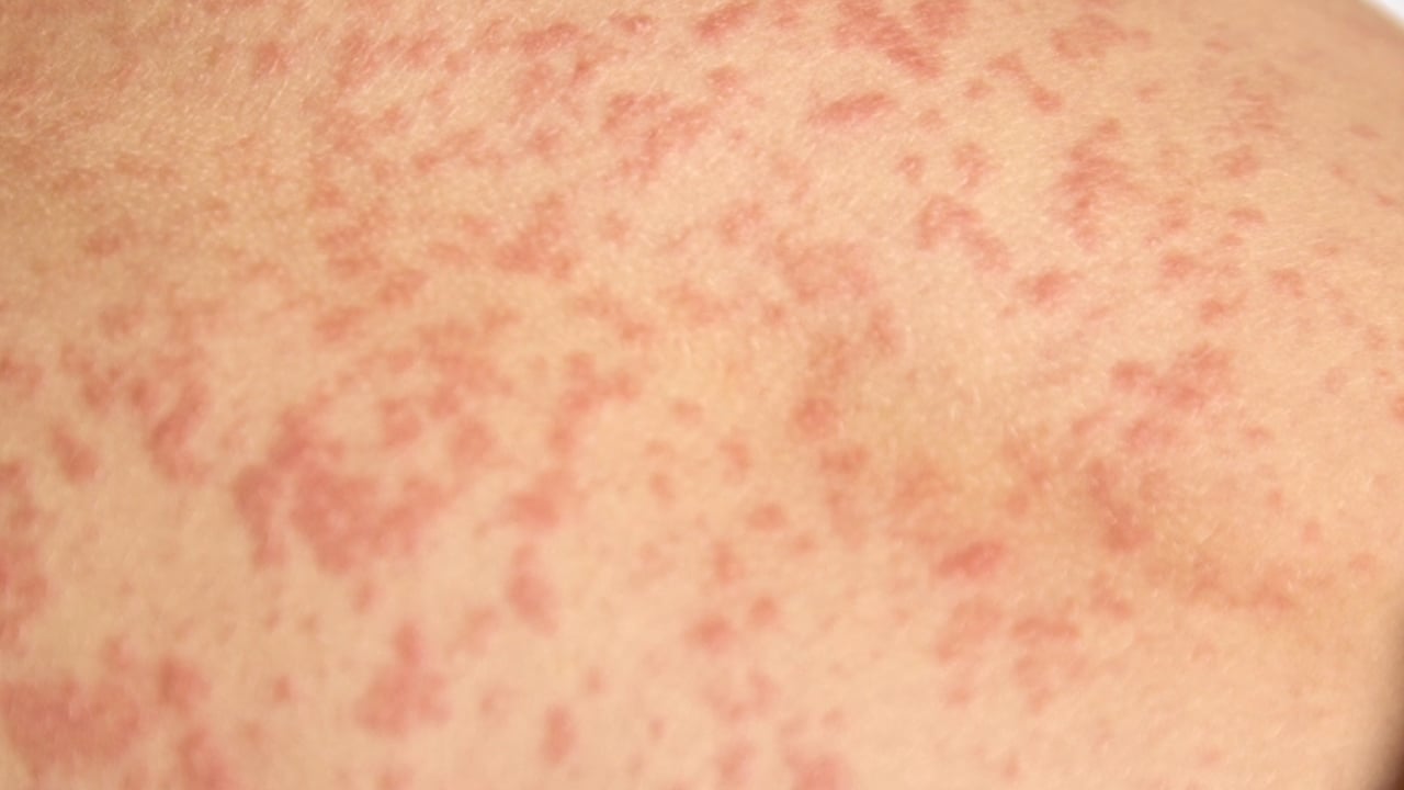 Foto - Uzmanı mesajı verdi: Besini tüketirken çözüm değil aksine bu hata kısa süre el ve ayaklarda şişmeye neden oluyor