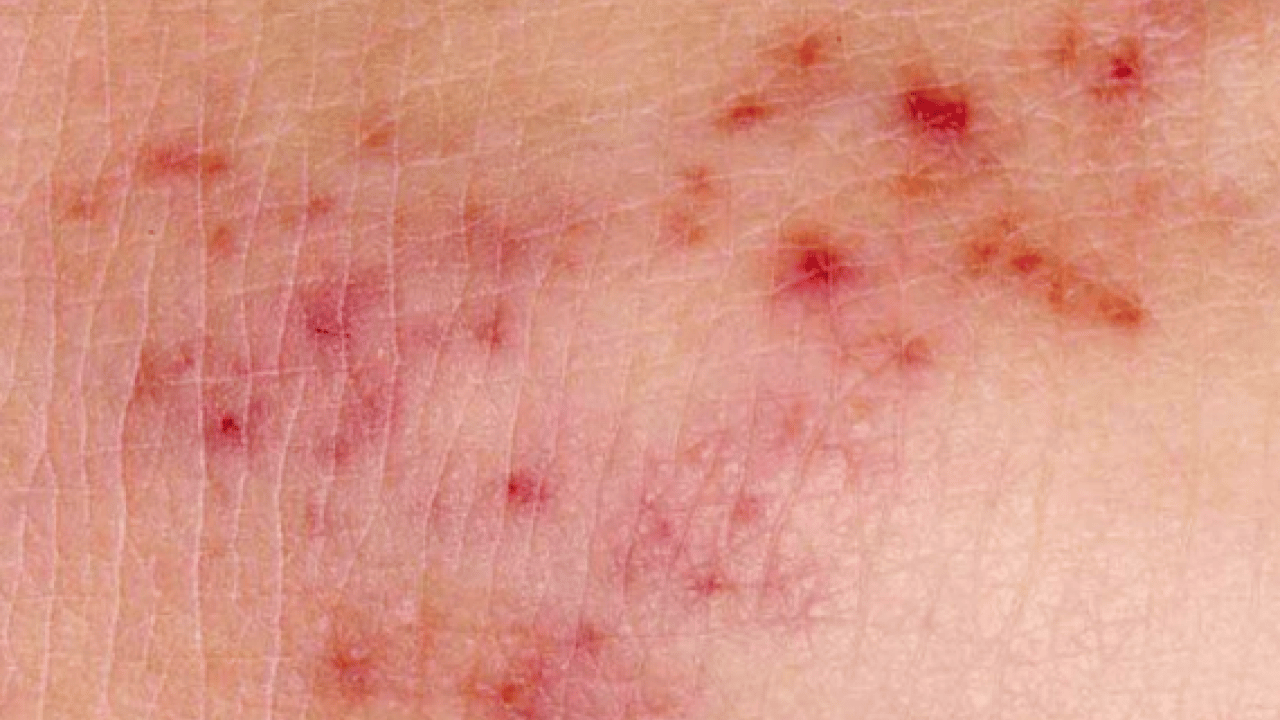 Foto - Doktor net konuştu: Menenjit hastalığından korunmanın en etkili yolu aşılanmaktır