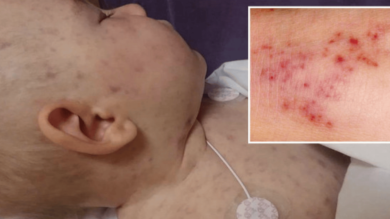 Doktor net konuştu: Menenjit hastalığından korunmanın en etkili yolu aşılanmaktır