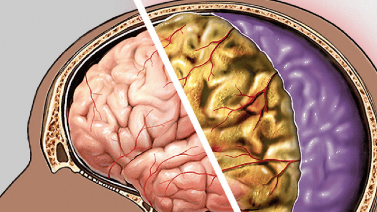 Foto - Doktor net konuştu: Menenjit hastalığından korunmanın en etkili yolu aşılanmaktır