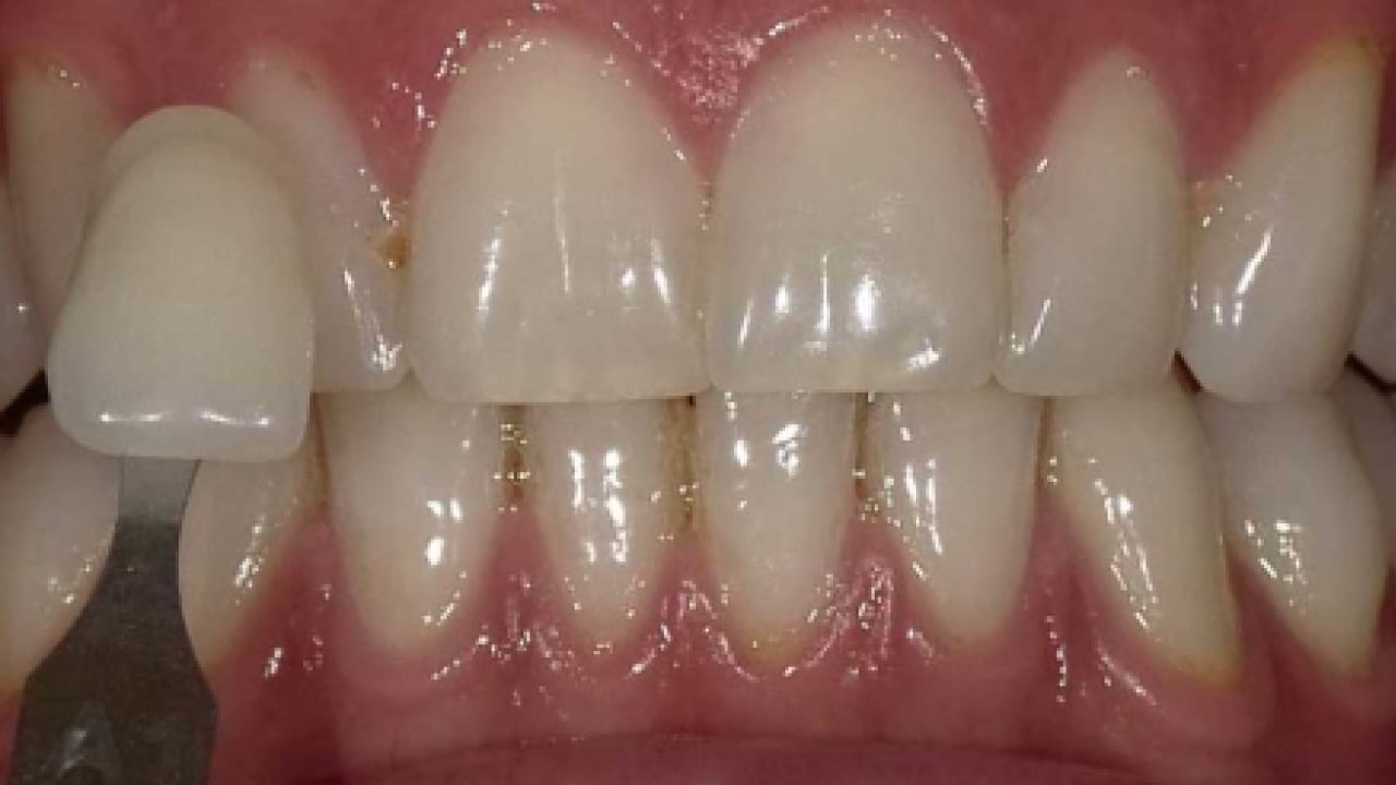 Foto - Uzmanı uyardı: Gülümseme uğruna sağlığınızdan olmayın!