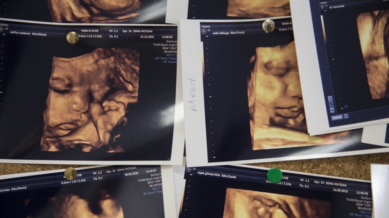 Foto - Uzmanından dikkat çeken uyarı! Annedeki o sorun bebeğinde hemofiliye yol açabiliyor