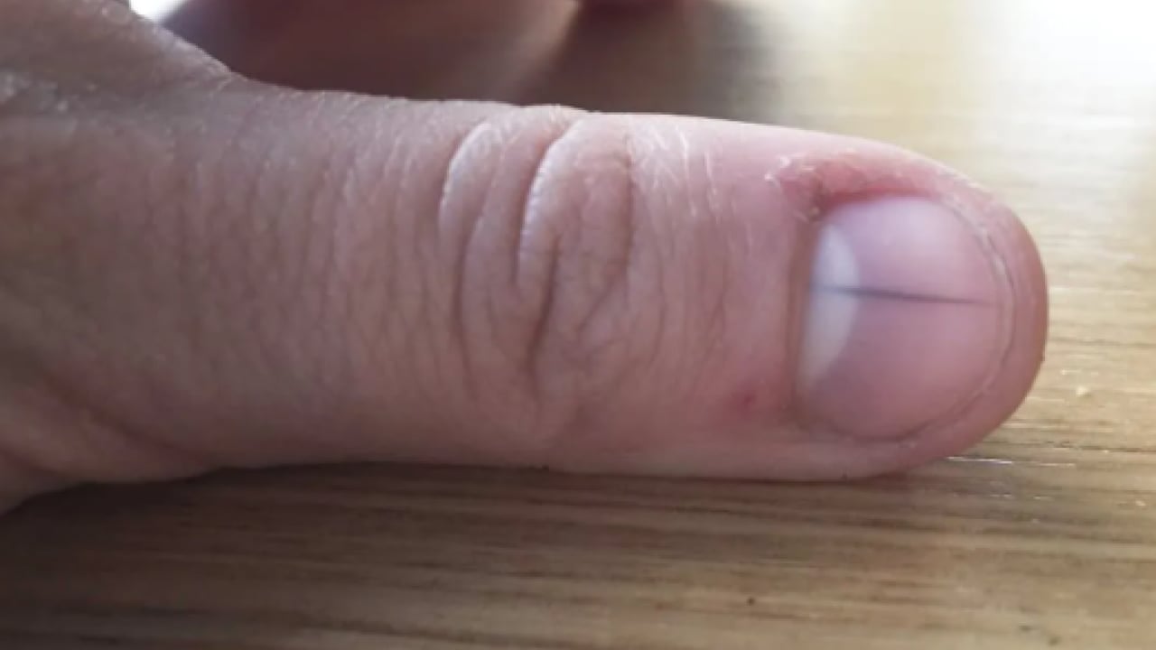 Foto - Uzmanından dikkat çeken uyarı! Tırnak altında leke varsa dikkat