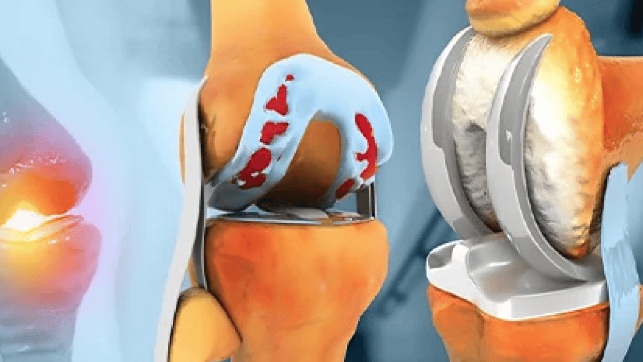 Foto - Uzmanından kritik uyarı: Dizde sesle birlikte ağrı, şişlik ve hareket kısıtlılığı varsa...