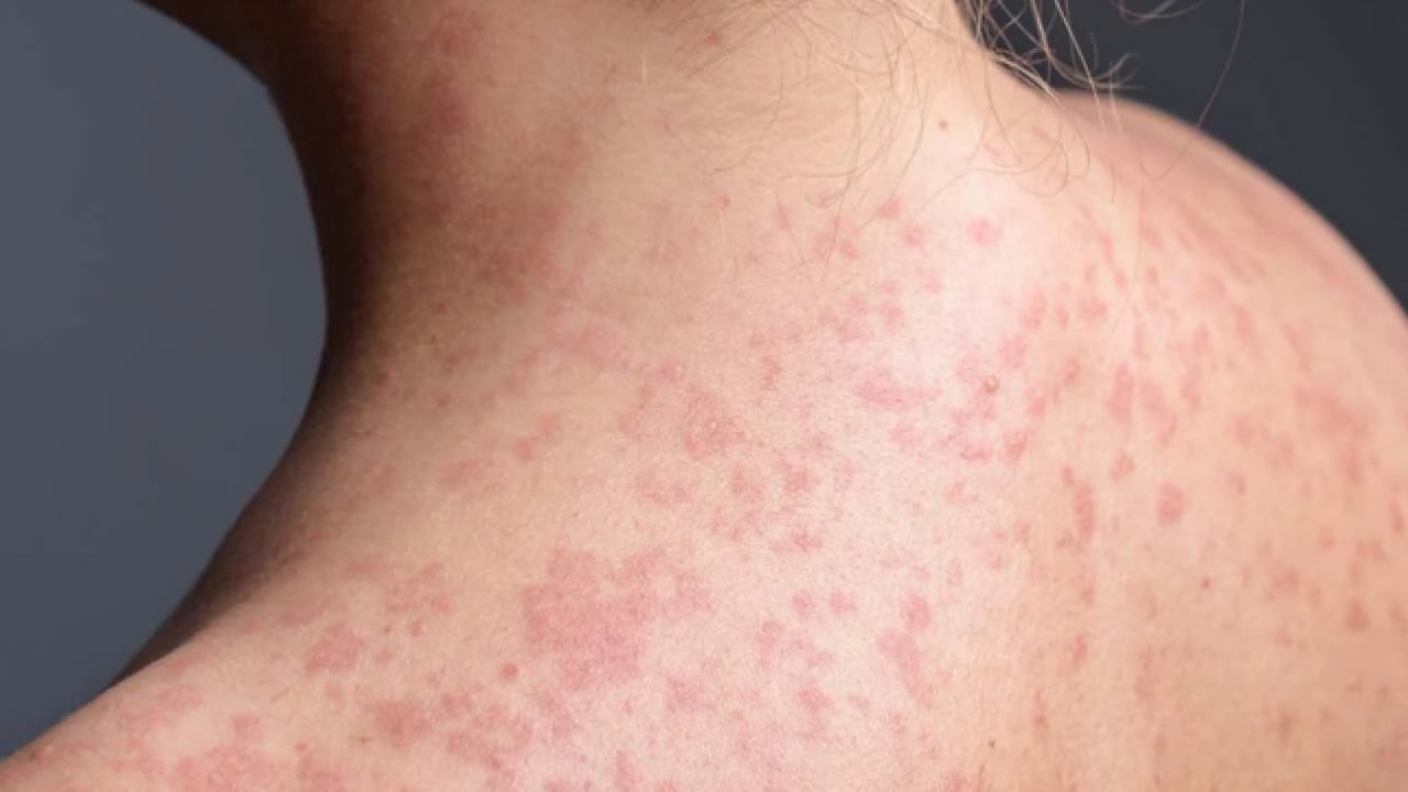 Foto - Uzmanından uyarı geldi! Vakalar artıyor! Yüksek bulaşıcılığı ve ciddi sonuçları var