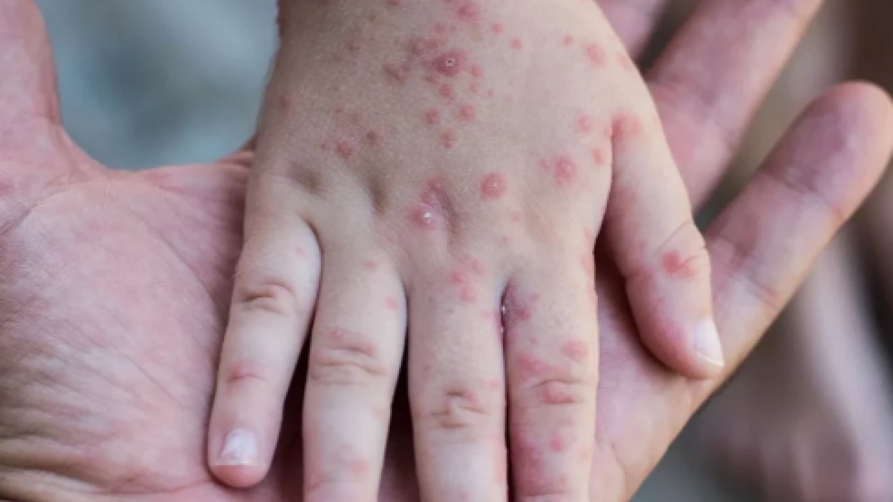 Foto - Uzmanından uyarı geldi! Vakalar artıyor! Yüksek bulaşıcılığı ve ciddi sonuçları var