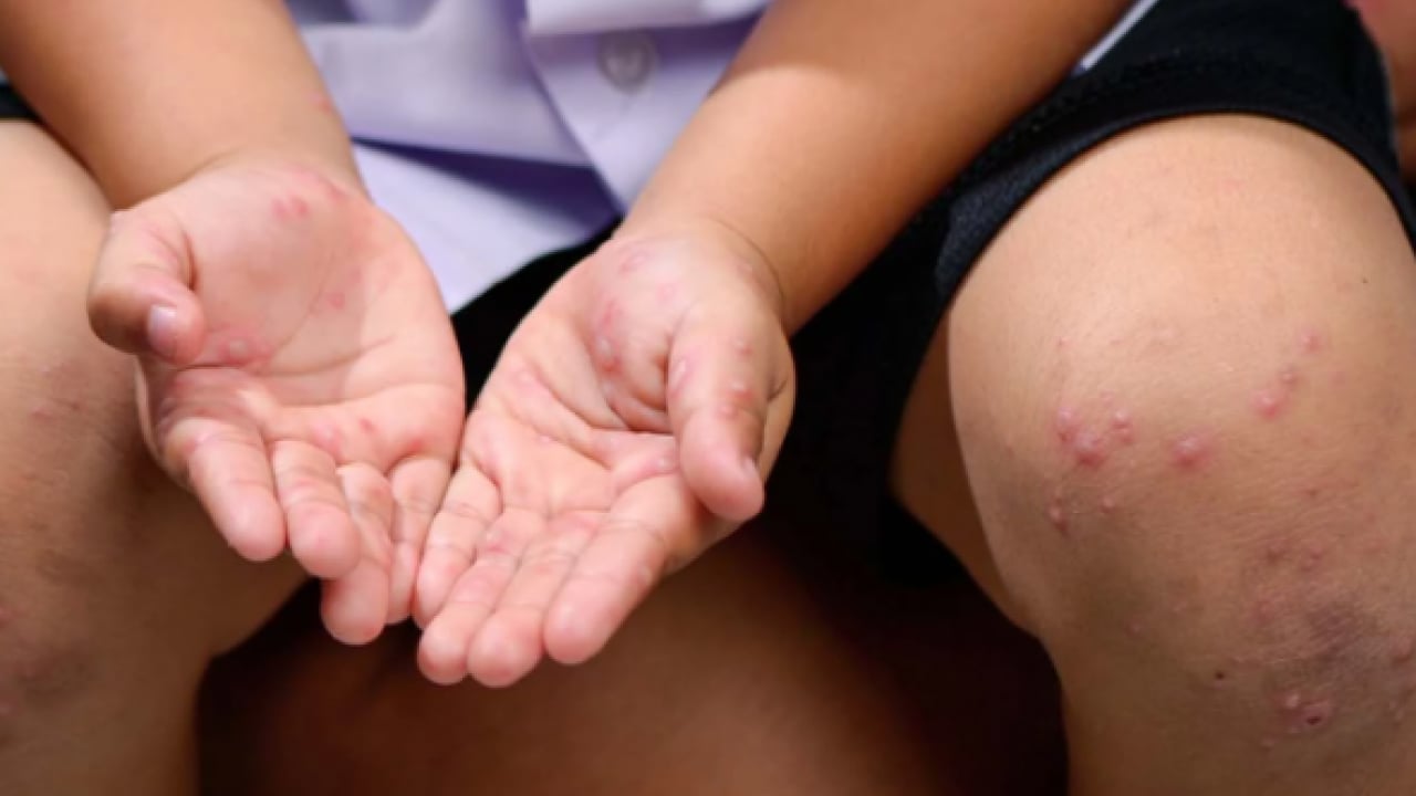 Foto - Uzmanından uyarı geldi! Vakalar artıyor! Yüksek bulaşıcılığı ve ciddi sonuçları var