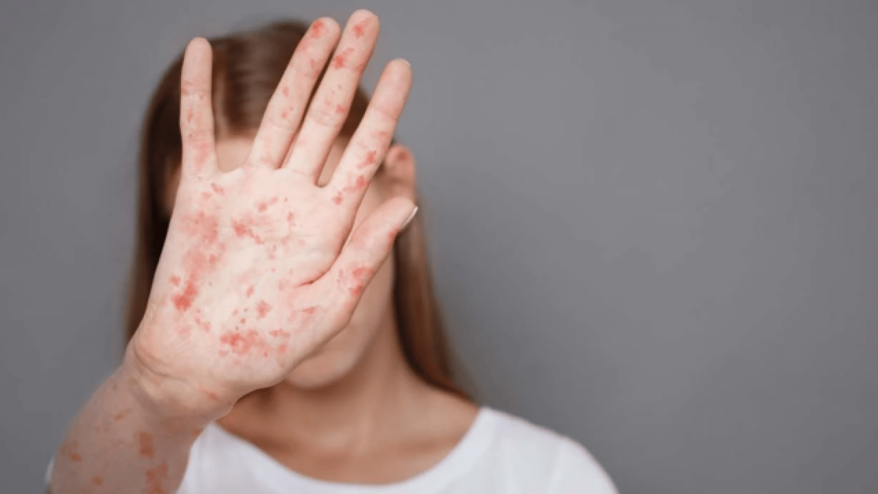 Foto - Uzmanından uyarı geldi! Vakalar artıyor! Yüksek bulaşıcılığı ve ciddi sonuçları var