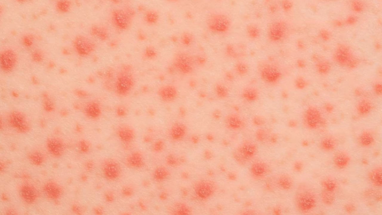 Foto - Uzmanından uyarı geldi! Vakalar artıyor! Yüksek bulaşıcılığı ve ciddi sonuçları var