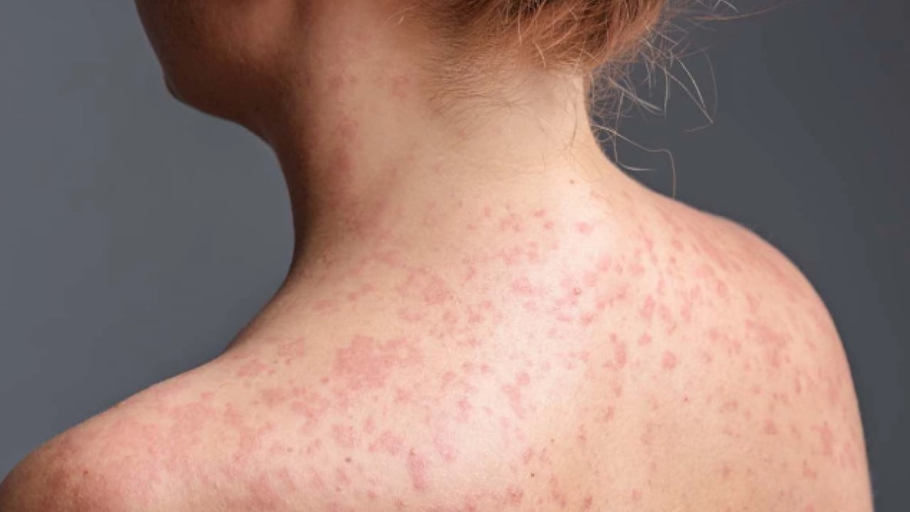 Foto - Uzmanından uyarı geldi! Vakalar artıyor! Yüksek bulaşıcılığı ve ciddi sonuçları var