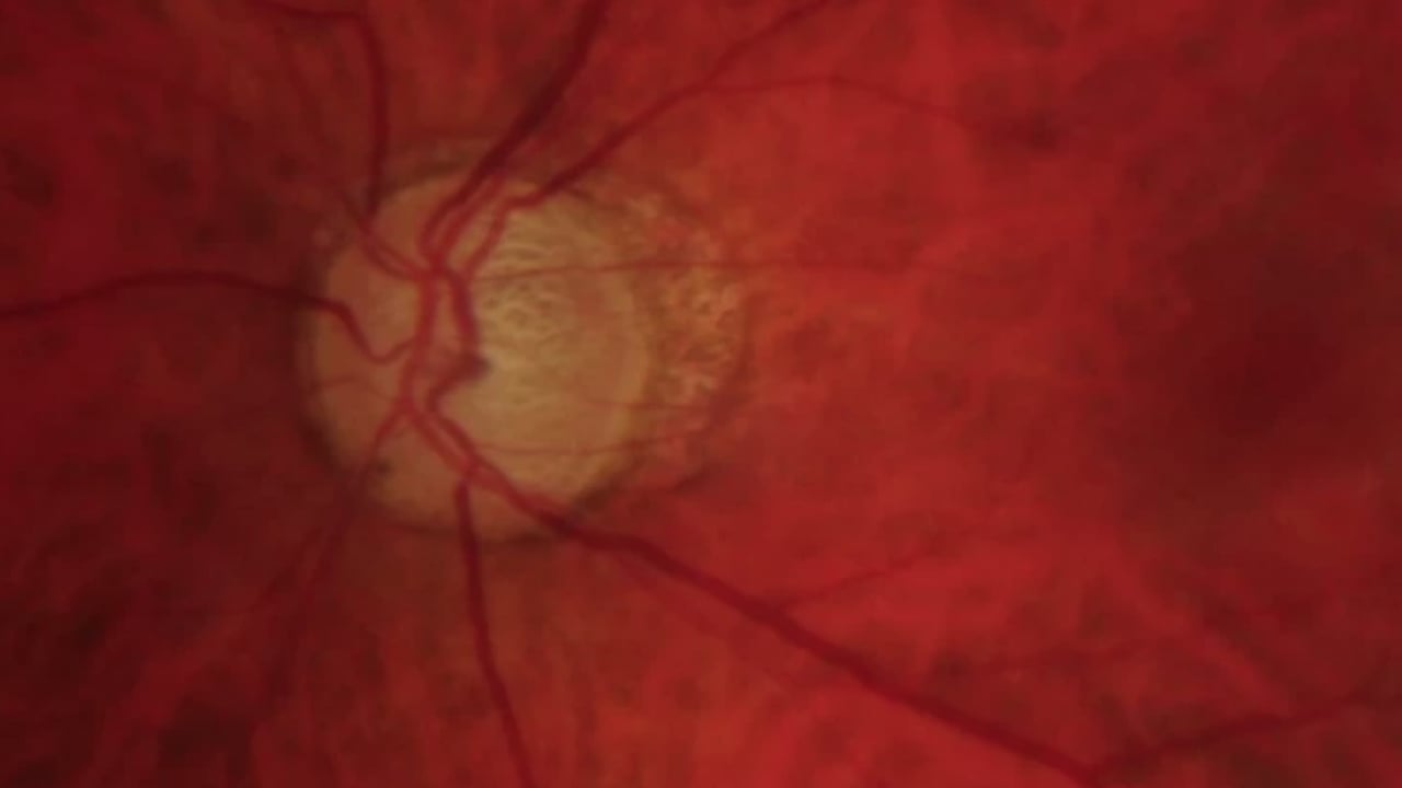 Foto - Uzmanlar açıkladı: Bu hastalık sessizce ilerliyor, teşhis gecikirse kör ediyor