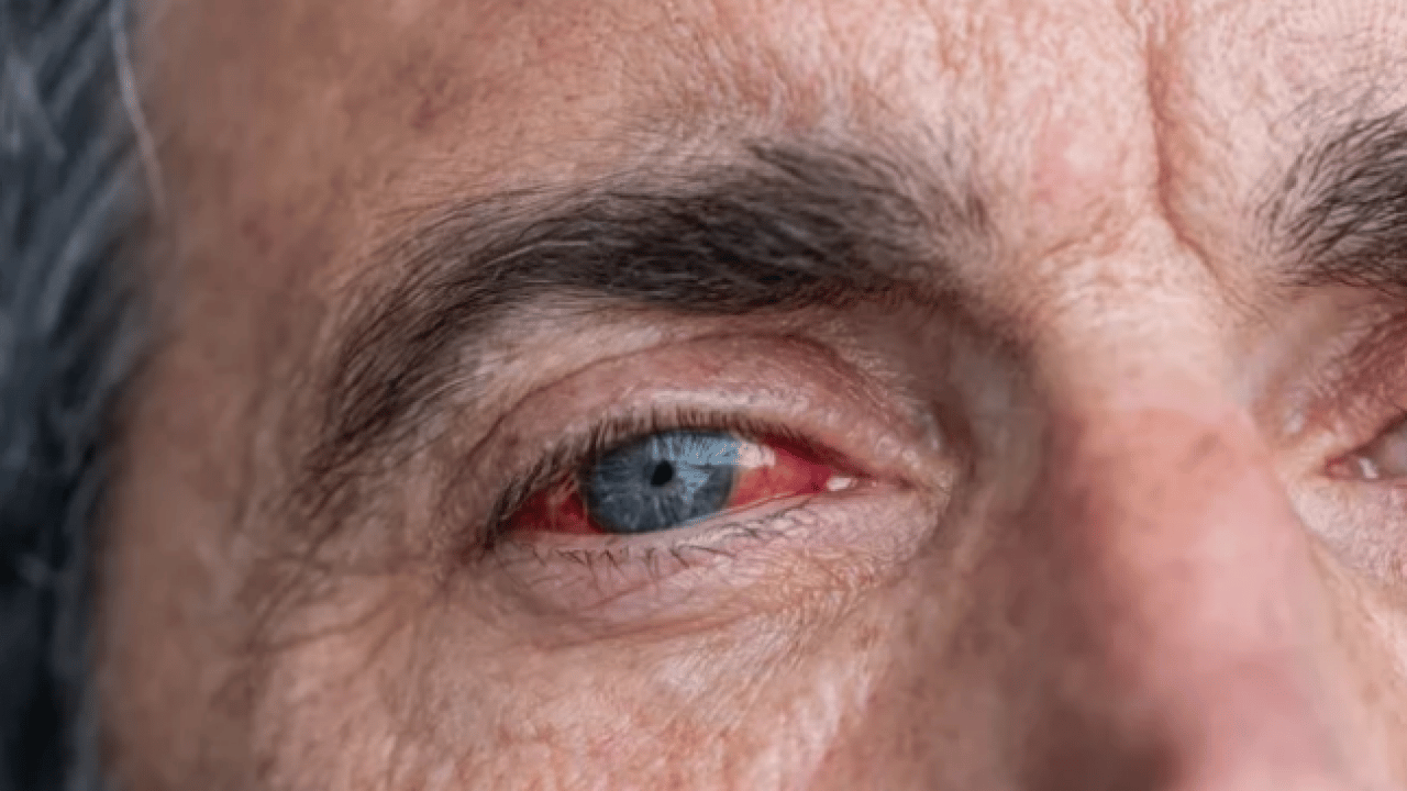 Foto - Uzmanlar açıkladı: Bu hastalık sessizce ilerliyor, teşhis gecikirse kör ediyor