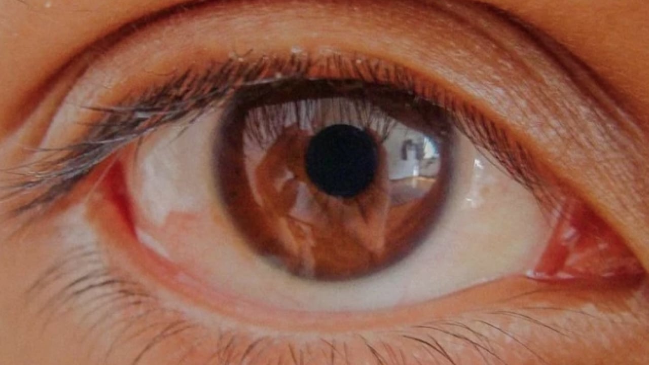 Foto - Uzmanlar açıkladı: Bu hastalık sessizce ilerliyor, teşhis gecikirse kör ediyor