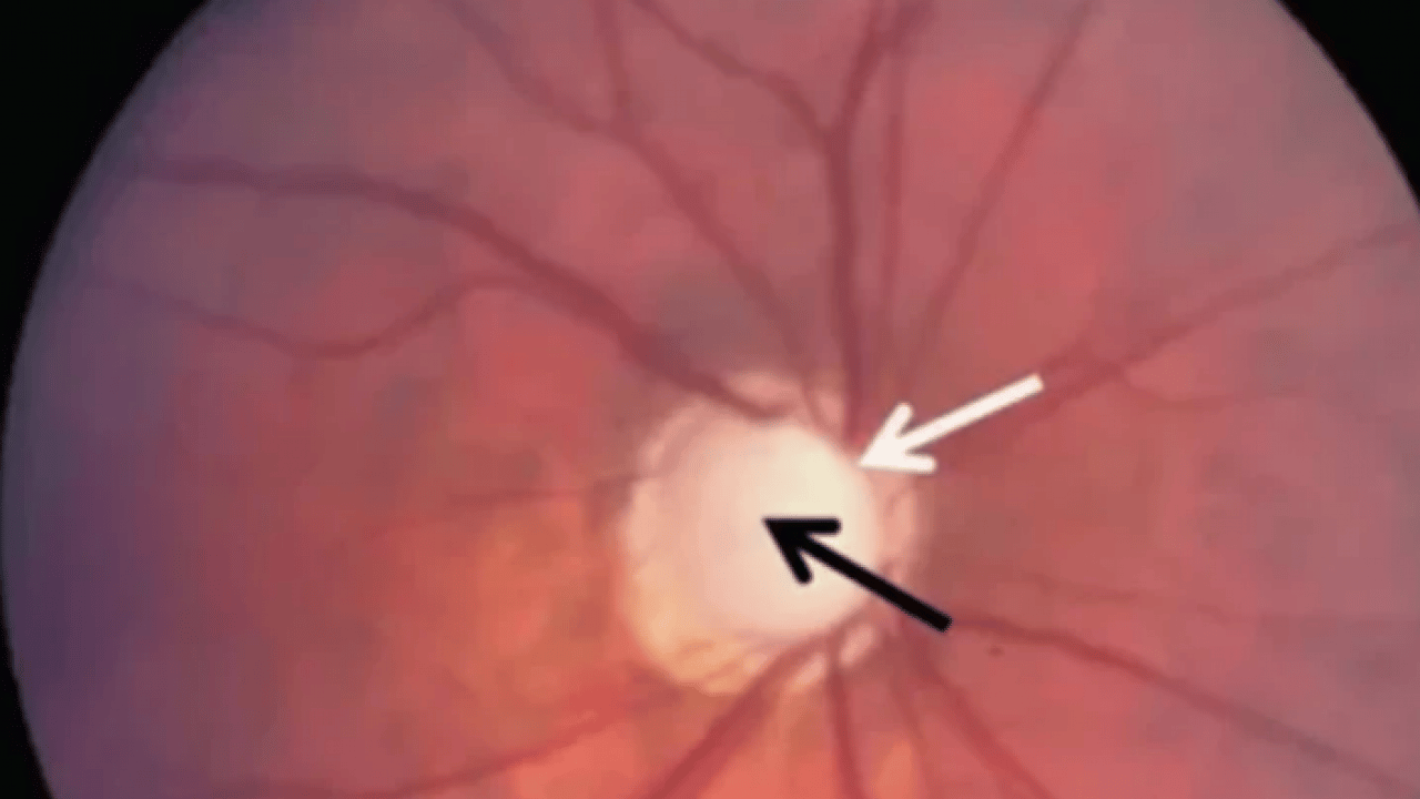 Foto - Uzmanlar açıkladı: Bu hastalık sessizce ilerliyor, teşhis gecikirse kör ediyor