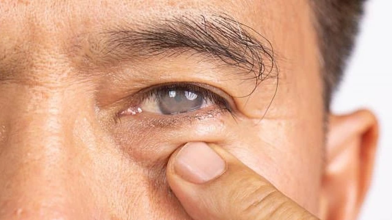 Foto - Uzmanlar açıkladı! Katarakt nasıl tedavi edilir?