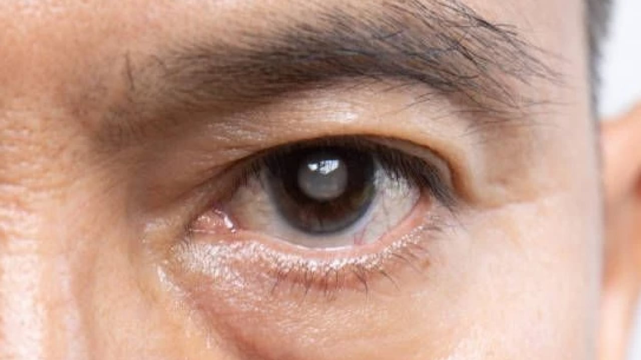 Foto - Uzmanlar açıkladı! Katarakt nasıl tedavi edilir?