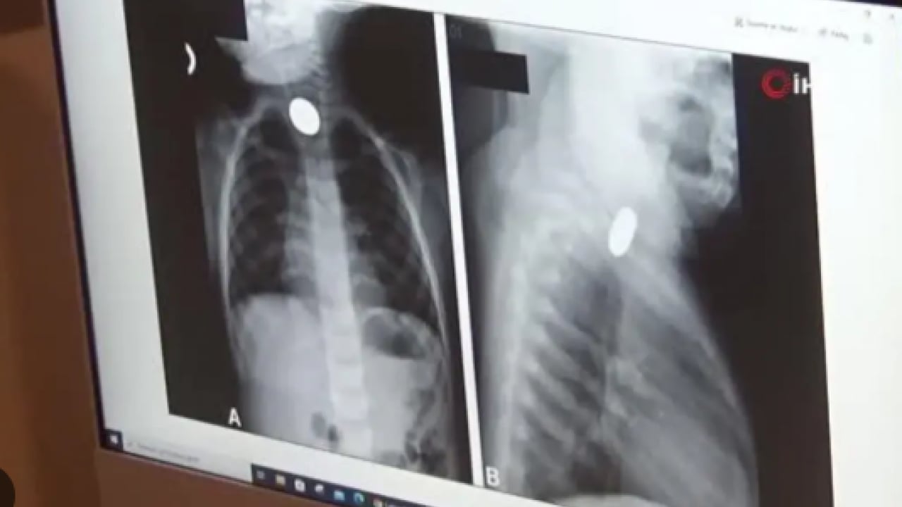 Foto - Ellerine geçmemesi lazım: İşte çocukların en kolay yuttuğu cisim!