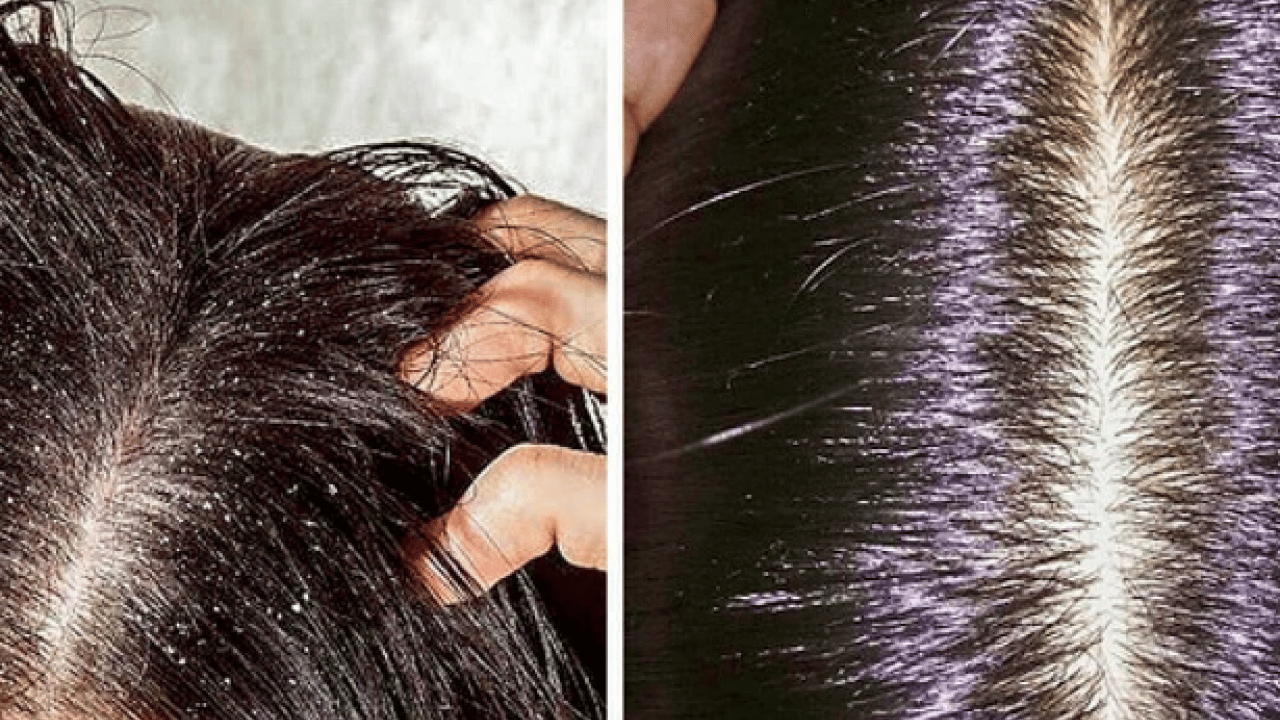 Foto - Islak saçla uyumak hastalık davetiyesi mi? Bağışıklık bariyerini zayıflatıyor