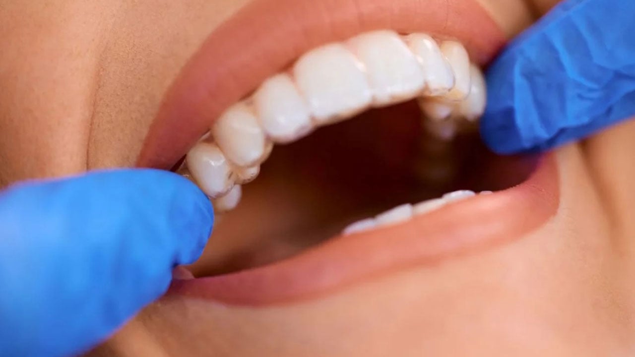 Uzmanlar üstüne basa basa uyarıyor! Bembeyaz dişlerle gelen kapkapara gelecek