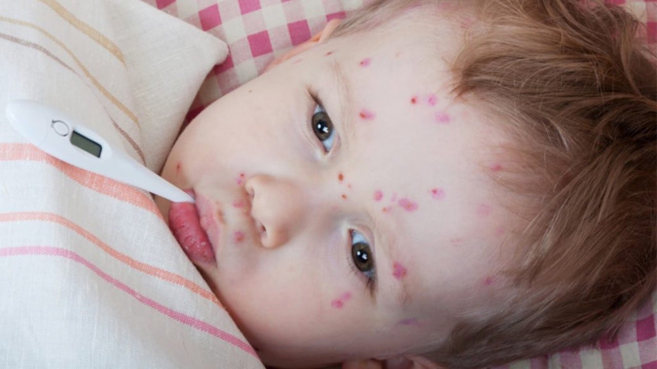 Foto - Uzmanlar uyardı! Çocuklarda bakteriyel menenjit ciddiye alınmalı