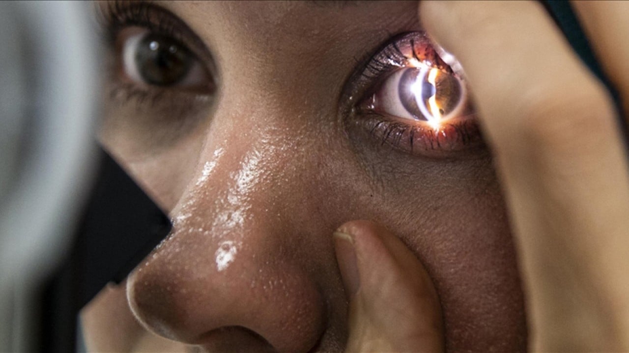 Uzmanlar uyardı! Sahte alkol gözde geri dönülmez hasarlara yol açabiliyor