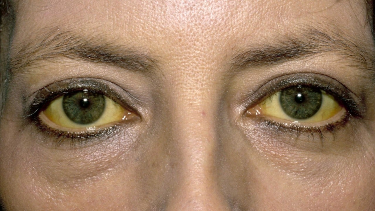 Foto - Uzmanlar uyardı! Sahte alkol gözde geri dönülmez hasarlara yol açabiliyor