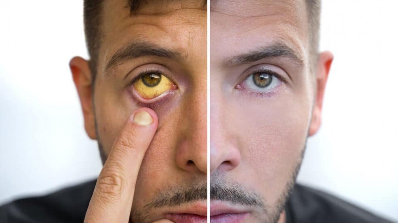 Foto - Uzmanlar uyardı! Sahte alkol gözde geri dönülmez hasarlara yol açabiliyor